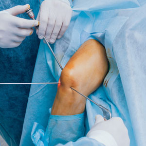 arthroscopy in Guntur