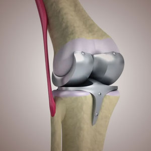 therapy free total knee replacement